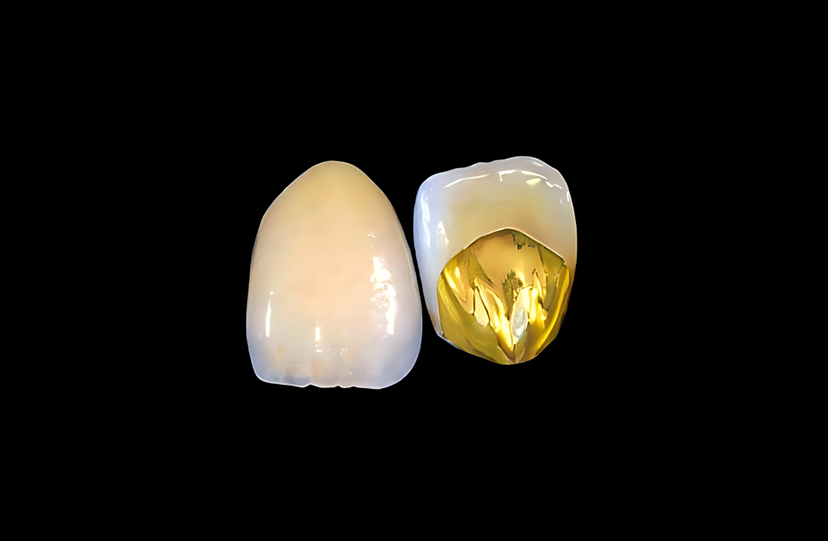 Au-Pd-Ag PFM